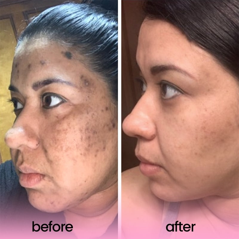 KojiPure: Viral Turmeric & Kojic Acid Cleansing Pads